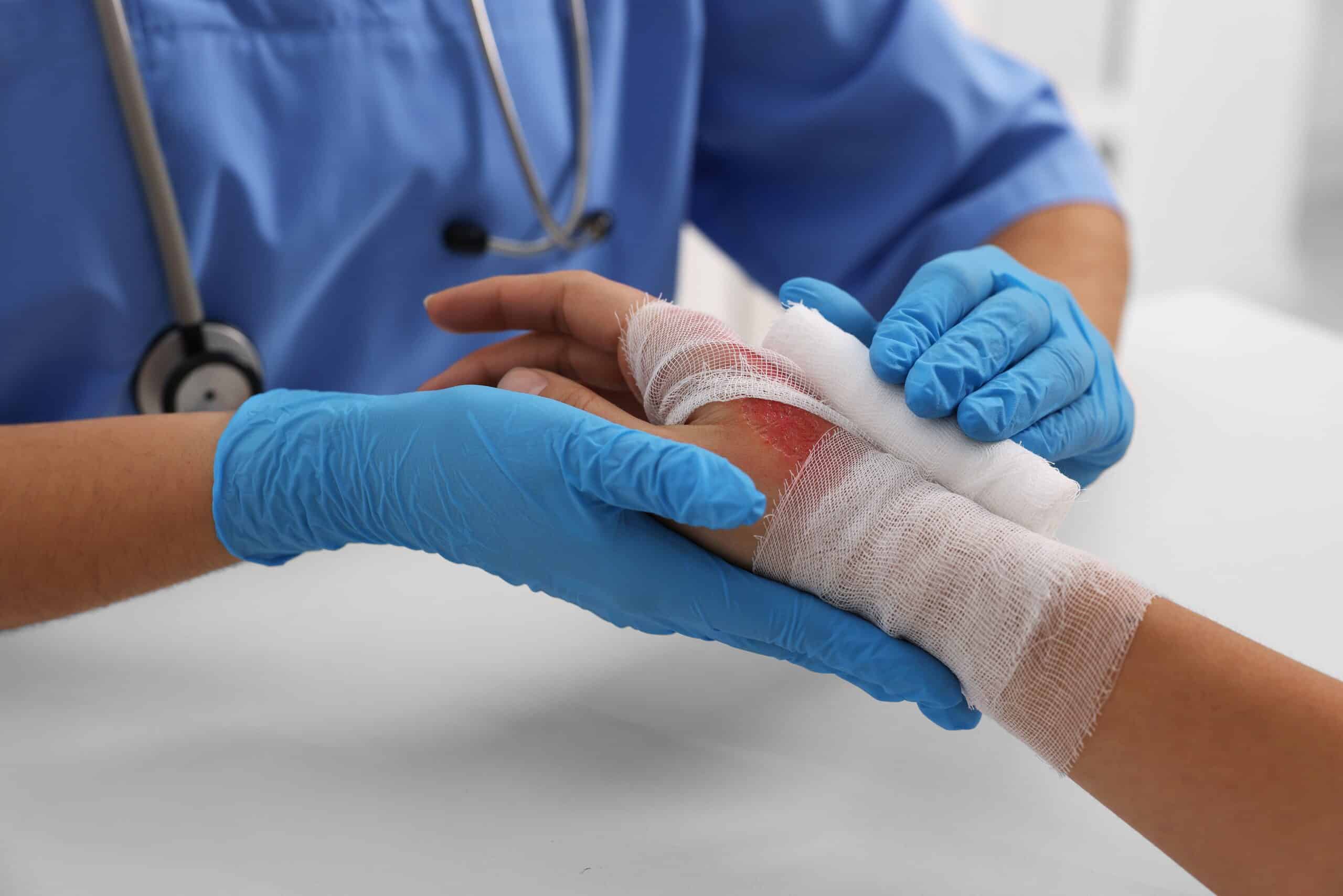 A medical professional wearing blue gloves carefully wraps a sterile white gauze bandage over a severe skin burn on a patient's hand, illustrating trauma injuries handled by Scranton Burn Injury Lawyers.