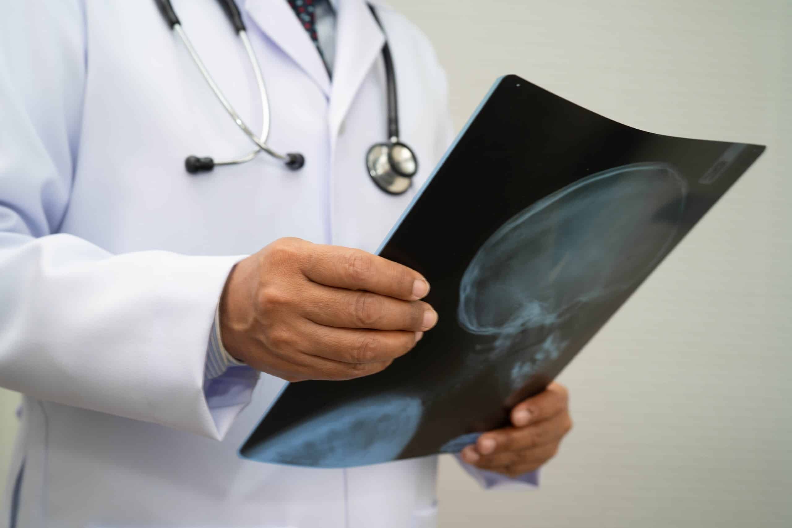 A doctor with a stethoscope holds a dark radiographic film displaying an anatomical head and neck scan, representing diagnostic tracking for clients of Scranton Spinal Cord Injury Lawyers.