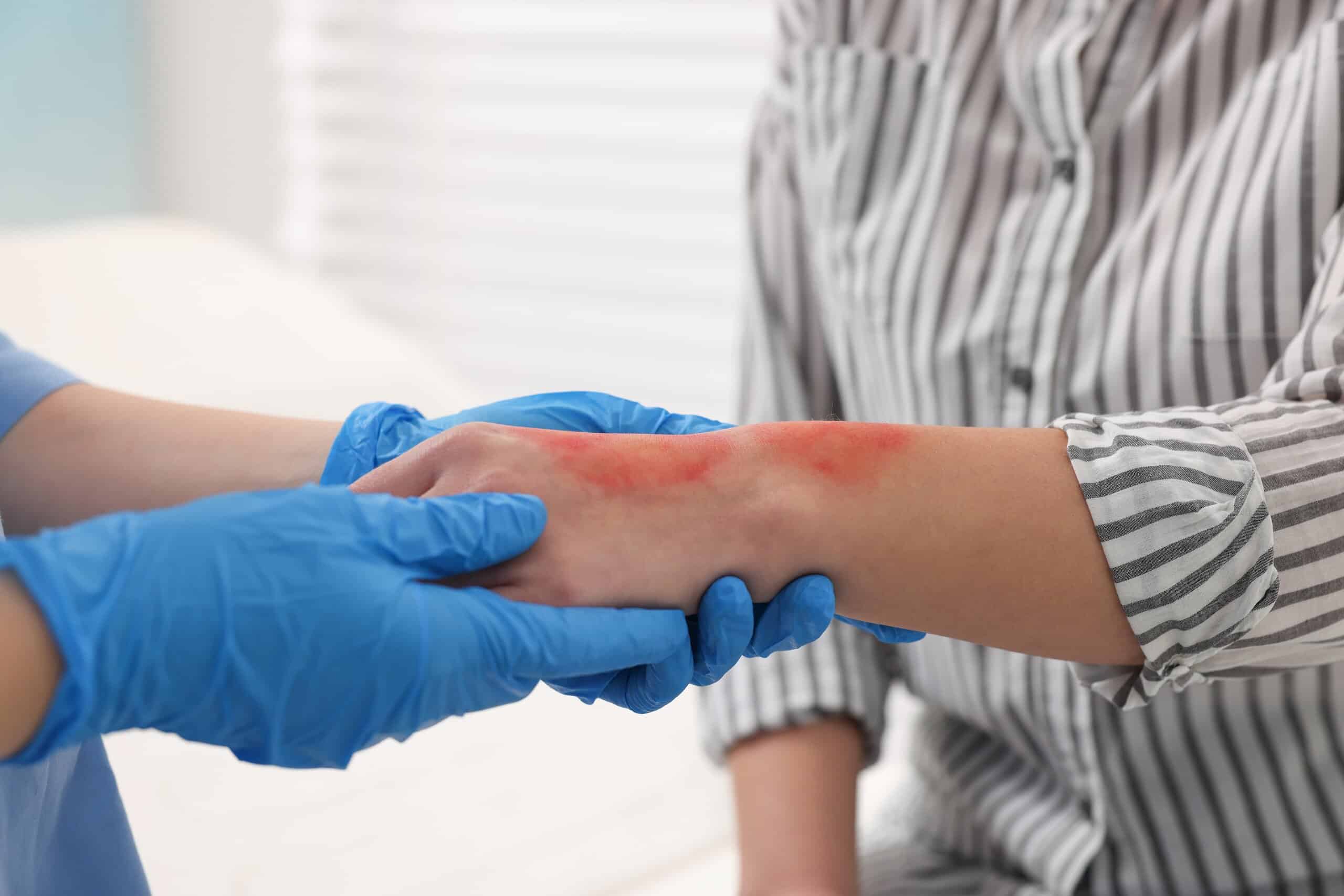 A medical professional holding a patient burned arm for a case evaluated by Philadelphia burn injury lawyers."